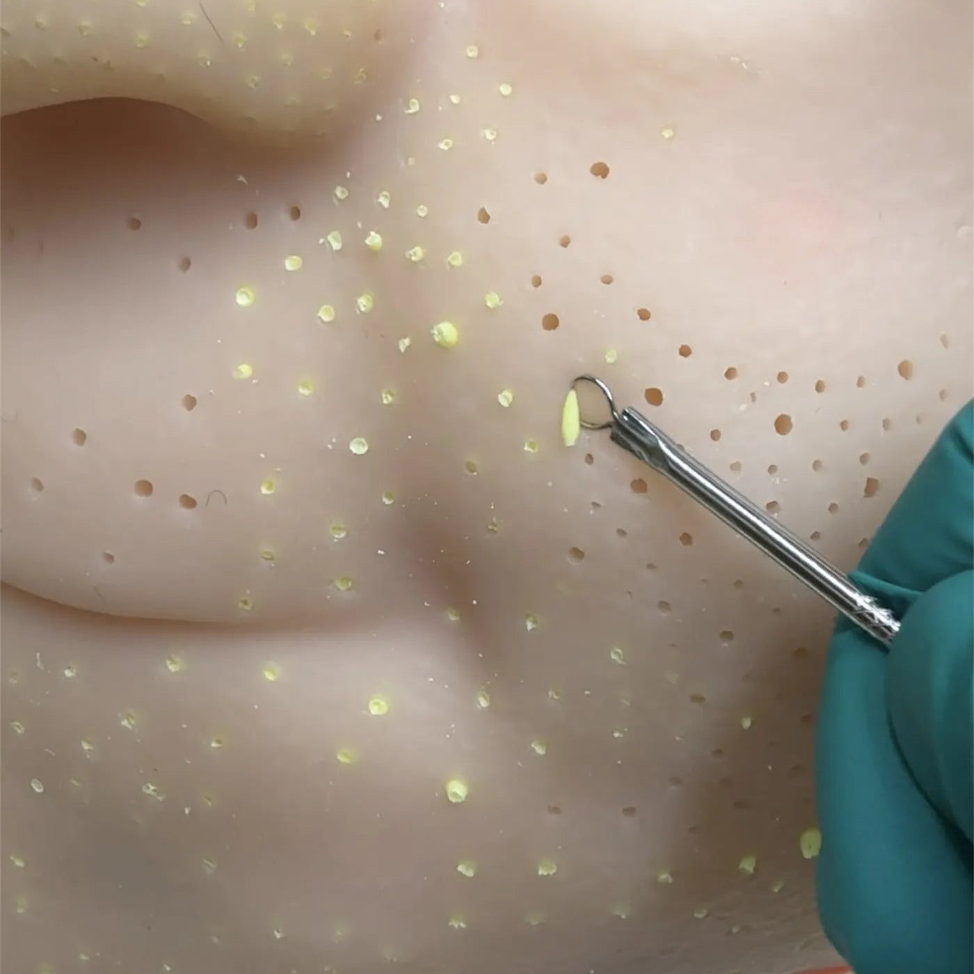 Close-up of a needle being inserted into skin with a gloved hand holding it, on a light background.